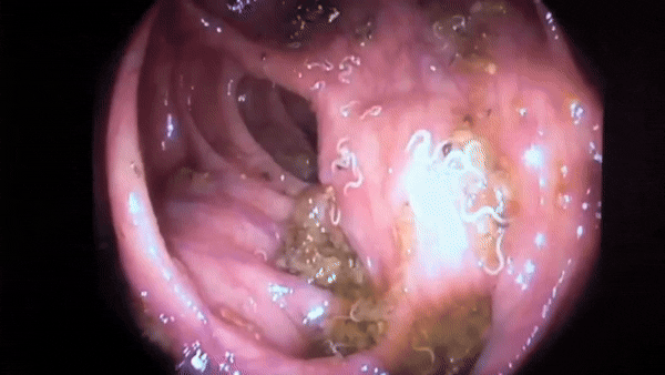 Animación intestinal del advertorial original
